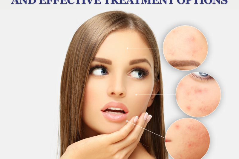 Understanding Acne: Causes, Types, and Effective Treatment Options
